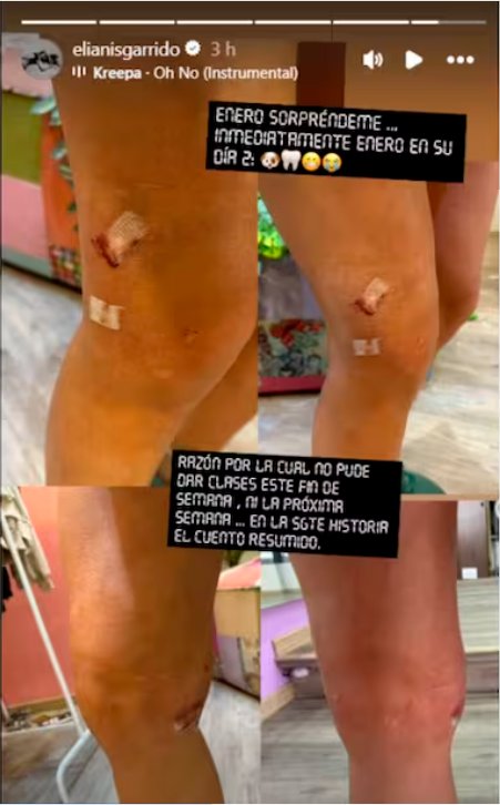Así luce la presentadora Elianis Garrido tras sufrir un accidente y ser mordida por su mascota Elianis Garrido, bailarina y presentadora, mostró sus heridas en sus redes sociales y contó qué fue lo que le pasó.