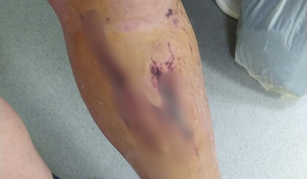 Taxista arrolló a Alan en Bosa y se fugó 1 Taxista arrolló a Alan en Bosa y se fugó Alan David Castillo, de 36 años, fue arrollado por un taxista que se dio a la fuga, causándole múltiples fracturas en su cuerpo. Ahora, exige que el conductor responda por los daños.