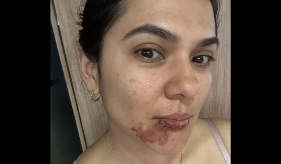 Mujer en Medellín sufrió quemadura en el rostro por una empanada que explotó Joven sufrió una quemadura en su rostro después de que una empanada que había preparado explotara justo cuando la estaba mordiendo.