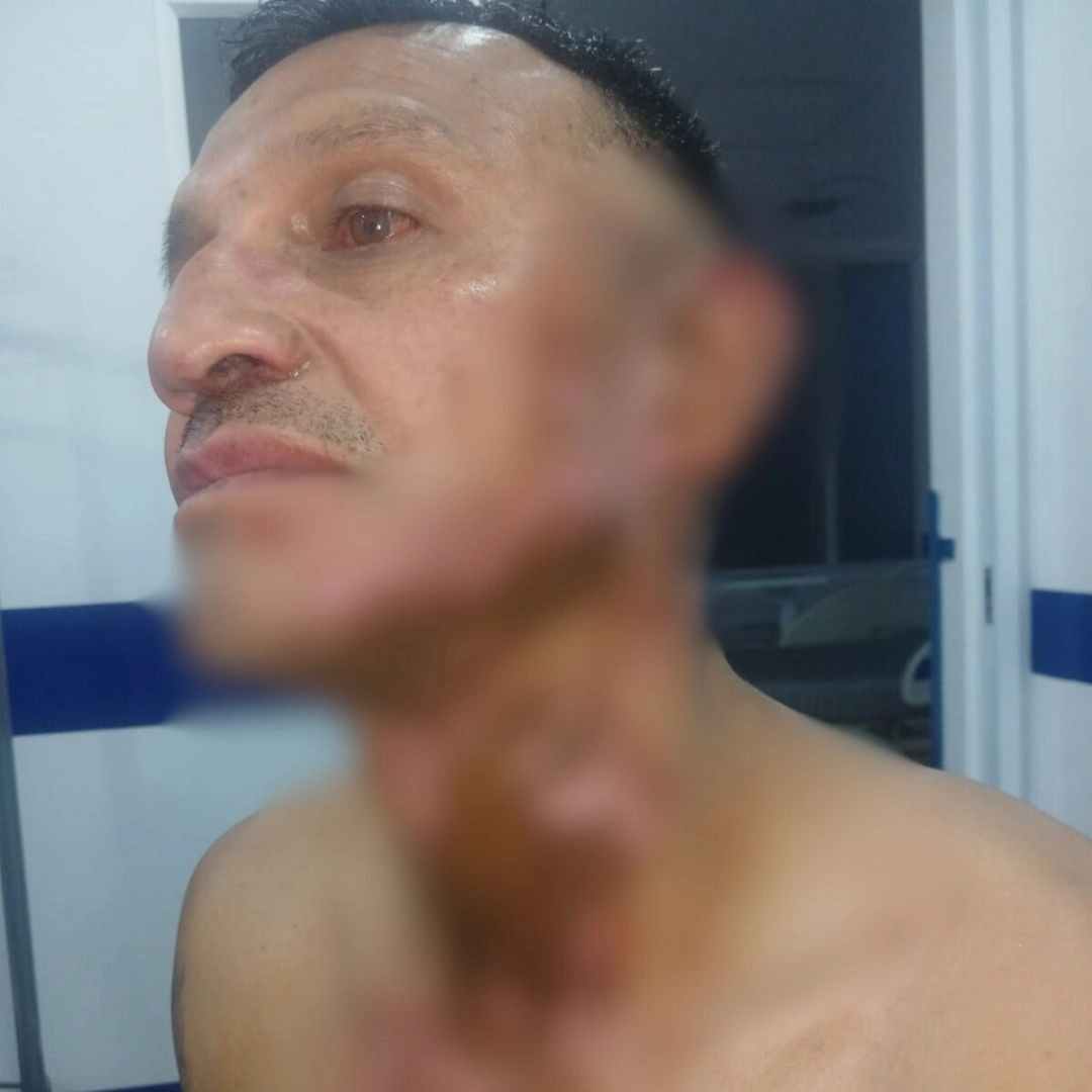 Indignante ataque con ácido en Fontibón: agresor permanece libre a pesar de pruebas 4 Indignante ataque con ácido en Fontibón: agresor permanece libre a pesar de pruebas Un padre de familia y maestro de obra fue brutalmente atacado con ácido en Fontibón, solo por reclamar un acto de intolerancia. Lo más indignante es que su agresor está libre, a pesar de las pruebas.