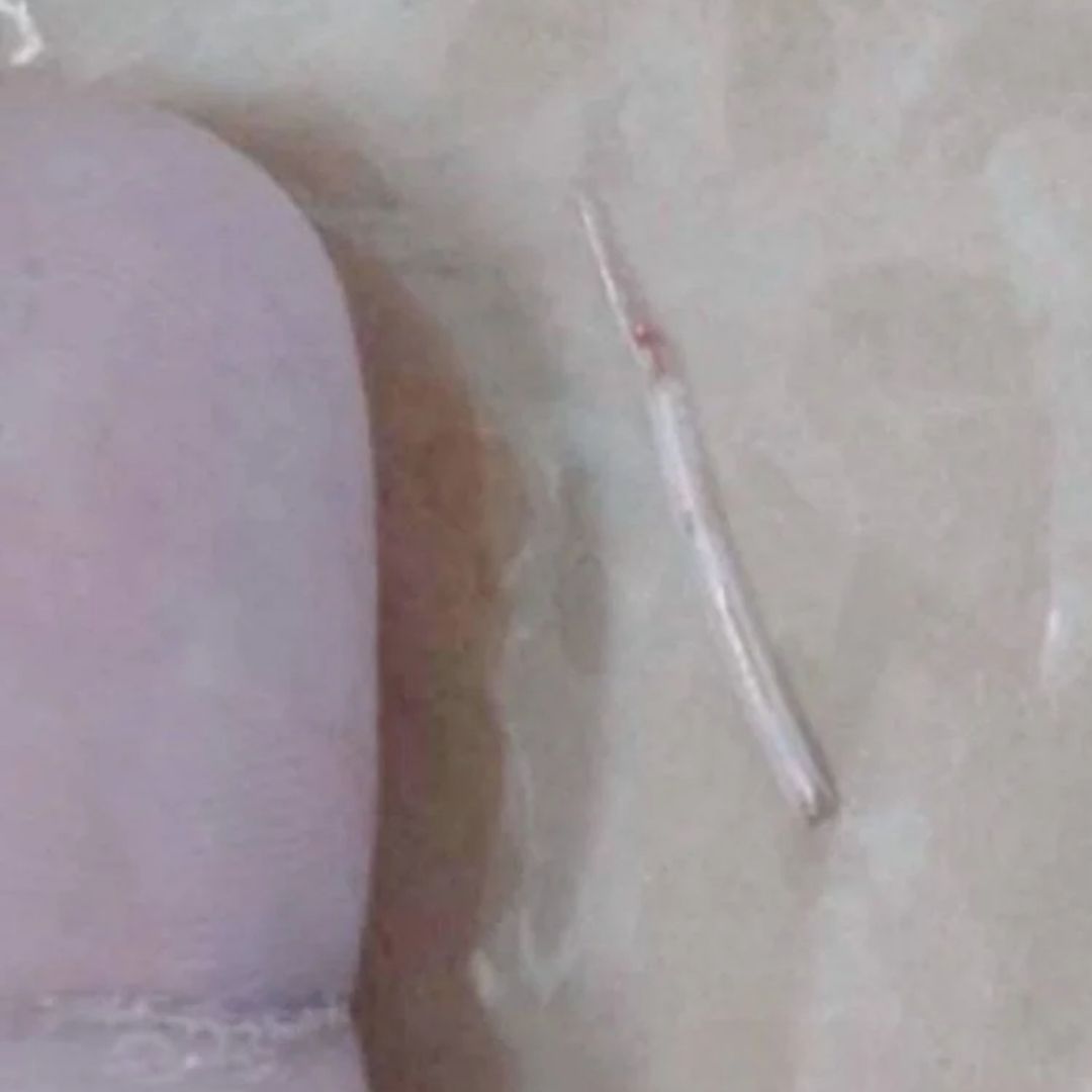 Pensó que era solo dolor de garganta… ¡y era una espina saliéndole del cuello! Fue en casa, mientras se preparaba para aplicarse un parche de dolor, cuando ocurrió lo inesperado: al palpar el área afectada, notó algo duro presionando desde dentro.
