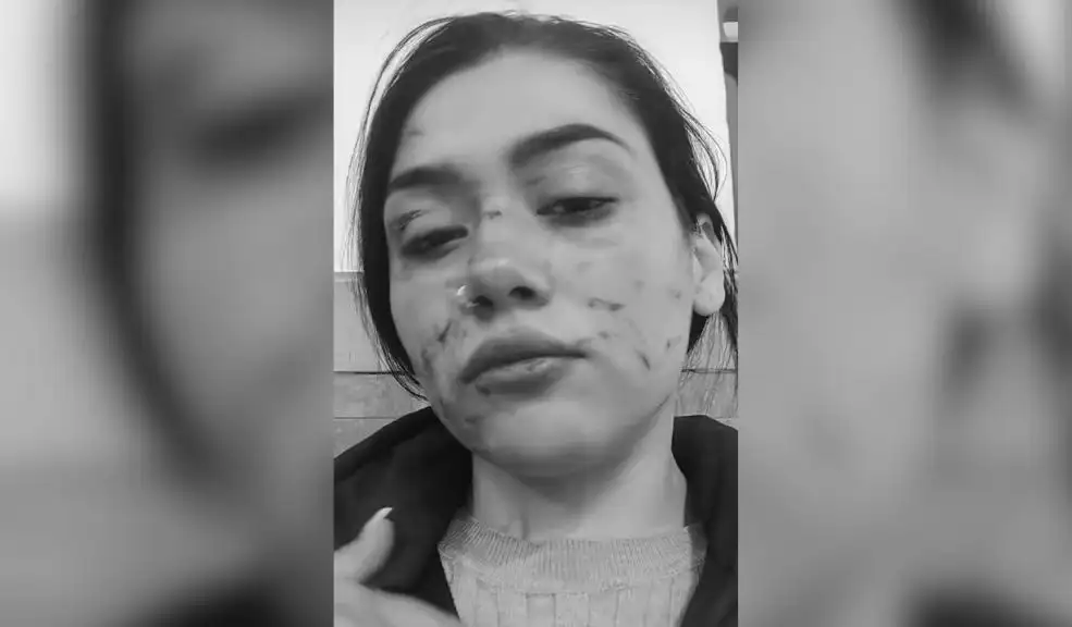Por vender gomitas en la carrera Séptima, joven fue gravemente herida en su rostro Leidy, la propietaria de un negocio ambulante de gomitas, fue gravemente herida en su rostro porque, al parecer, otras vendedoras no estaban de acuerdo con su presencia en el sector.