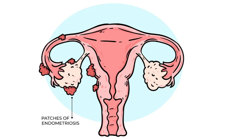 La endometriosis, enfermedad que afecta a muchas mujeres en el país, tiene al borde de la muerte a Viviana Tautiva 2 La endometriosis, enfermedad que afecta a muchas mujeres en el país, tiene al borde de la muerte a Viviana Tautiva Viviana Tautiva lucha por su vida a causa de la endometriosis, una enfermedad silenciosa que padecen miles de mujeres en Colombia y que aún no recibe la atención necesaria.