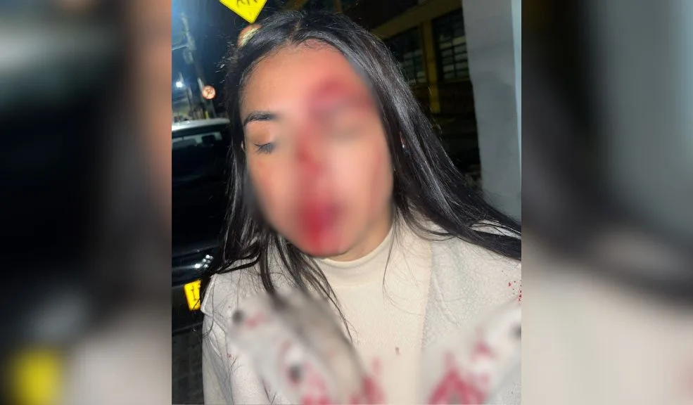 Cundinamarca: dos mujeres denuncian presunto caso de abuso policial Una celebración en el municipio de Tabio, Cundinamarca, terminó en un presunto caso de abuso policial contra dos mujeres que, según su relato, fueron agredidas por grabar a los uniformados. Una de ellas resultó con graves heridas en el rostro, mientras que la otra tiene dificultades para caminar