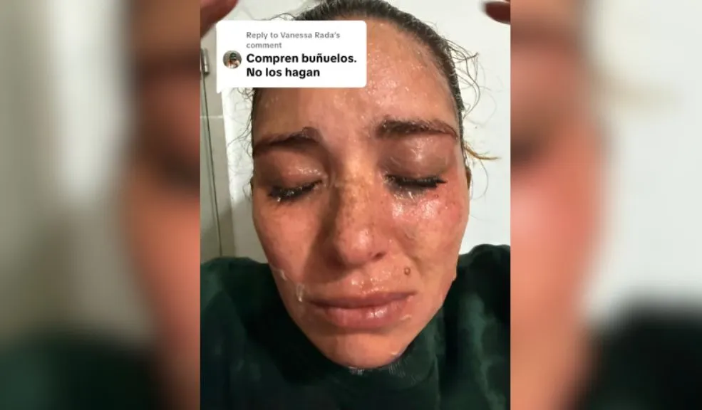 Adolescentes se quemaron la cara con 'buñuelos explosivos' En incidentes que han cobrado relevancia en plataformas digitales, dos jóvenes creadoras de contenido alertaron sobre los peligros de preparar buñuelos sin la técnica adecuada.