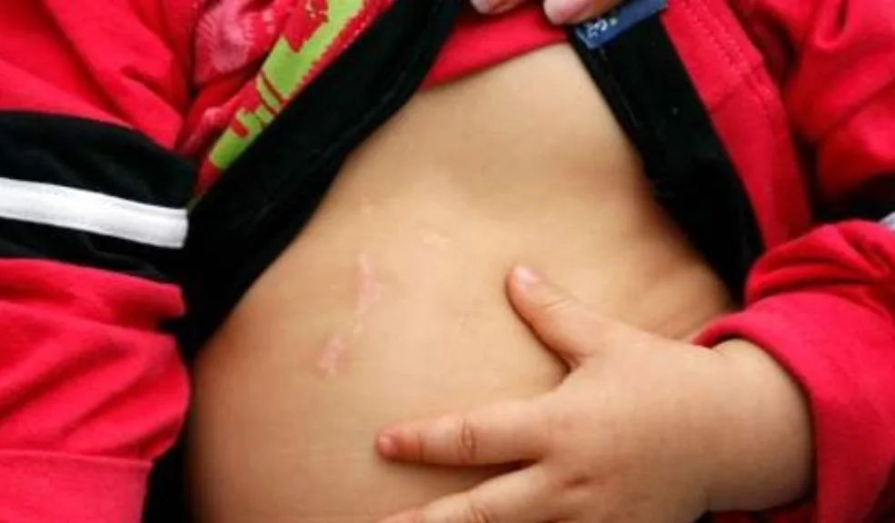 Menor de 4 años murió tras ser quemado con gasolina y varios días de agonía 1 Menor de 4 años murió tras ser quemado con gasolina y varios días de agonía Un lamentable hecho le arrebató la vida a un niño de 4 años, luego de que otro menor manipulara una botella con gasolina y le causara graves quemaduras en gran parte de su cuerpo, lo que lo llevó a una agonía que se prolongó por varios días antes de fallecer.