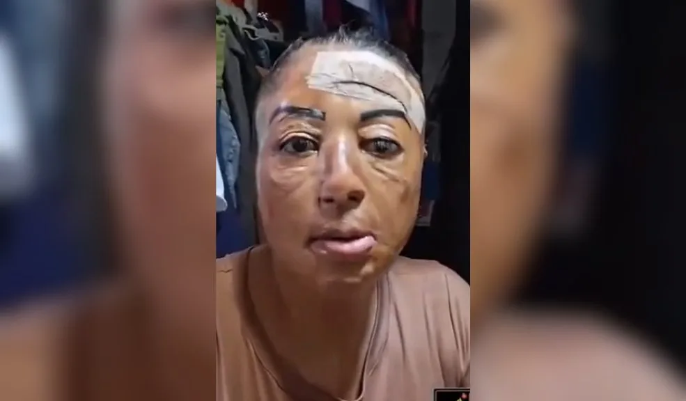 Video de testimonio: le explotó el celular mientras lo cargaba y escuchaba música Por medio de un video se conoció la historia de una mujer que recorre las calles de su ciudad para dejar una reflexión sobre el uso del celular mientras se encuentra cargando. Ella sufrió quemaduras de segundo y tercer grado en su rostro después de que tanto el teléfono como el cargador explotaran.