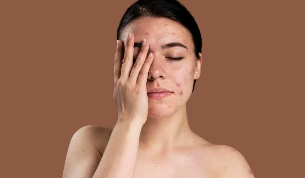 ¿Por qué da acné con la menopausia? 1 ¿Por qué da acné con la menopausia? Aunque el acné se considera tradicionalmente un desafío de la adolescencia, muchas mujeres se sorprenden al enfrentar brotes inflamatorios durante la menopausia.